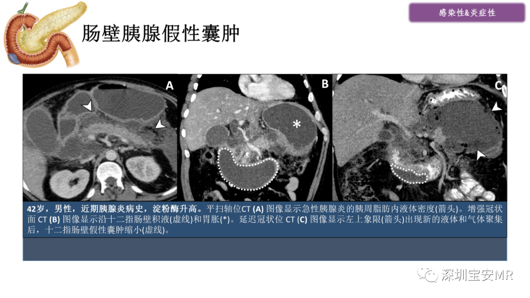 影像PPT - 【PPT】十二指肠疾病影像表现-10