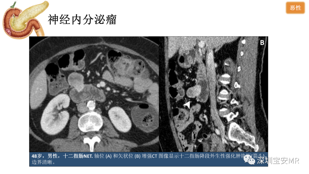 影像PPT - 【PPT】十二指肠疾病影像表现-20