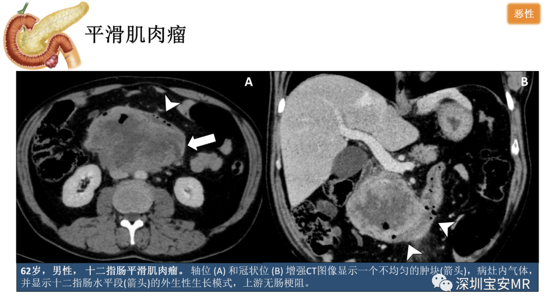 影像PPT - 【PPT】十二指肠疾病影像表现-24