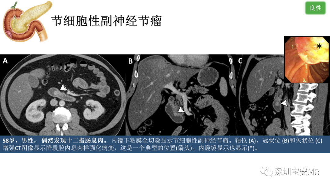 影像PPT - 【PPT】十二指肠疾病影像表现-26