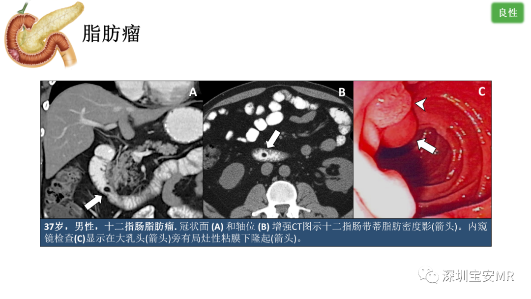 影像PPT - 【PPT】十二指肠疾病影像表现-28