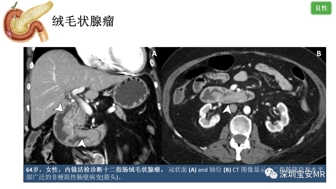 影像PPT - 【PPT】十二指肠疾病影像表现-30