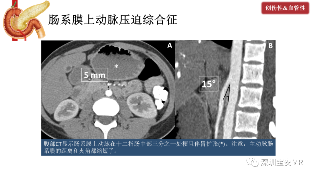 影像PPT - 【PPT】十二指肠疾病影像表现-34