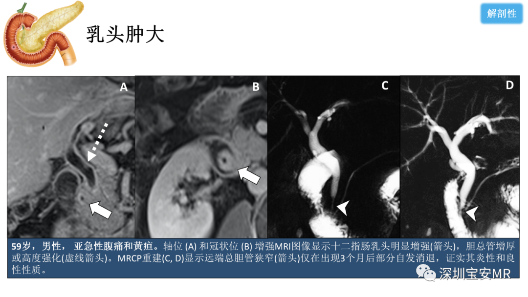 影像PPT - 【PPT】十二指肠疾病影像表现-36