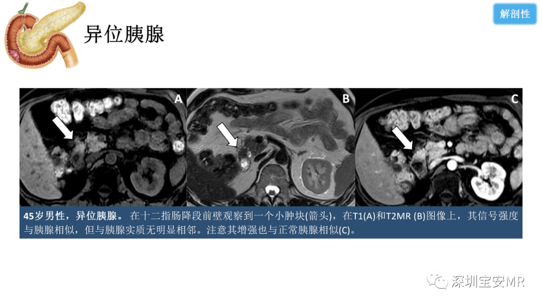 影像PPT - 【PPT】十二指肠疾病影像表现-38