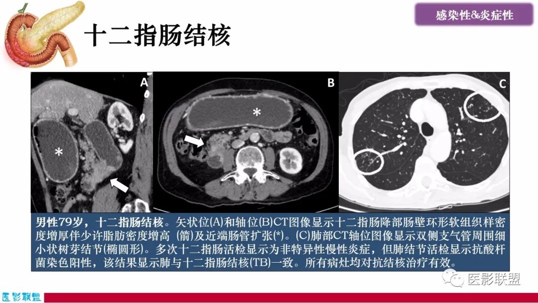 影像PPT - 【PPT】十二指肠断面成像：疾病谱-6