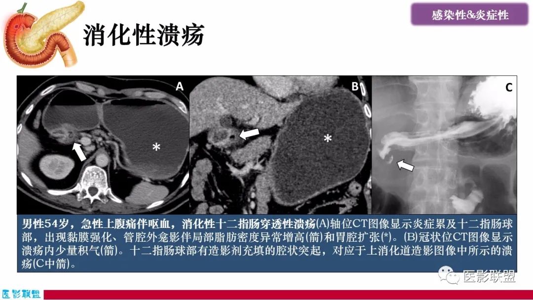 影像PPT - 【PPT】十二指肠断面成像：疾病谱-8