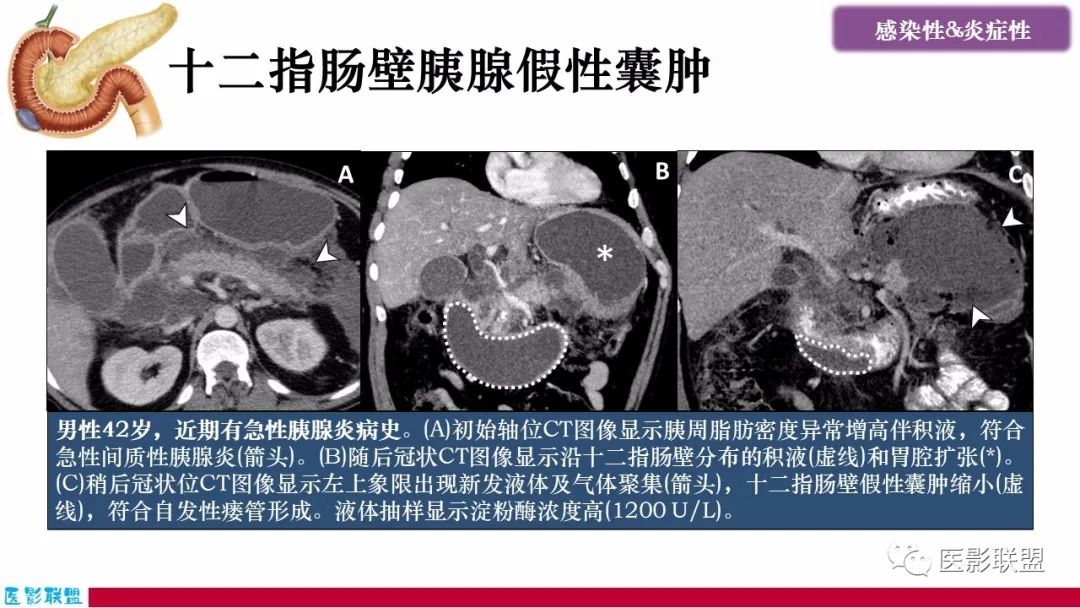 影像PPT - 【PPT】十二指肠断面成像：疾病谱-10