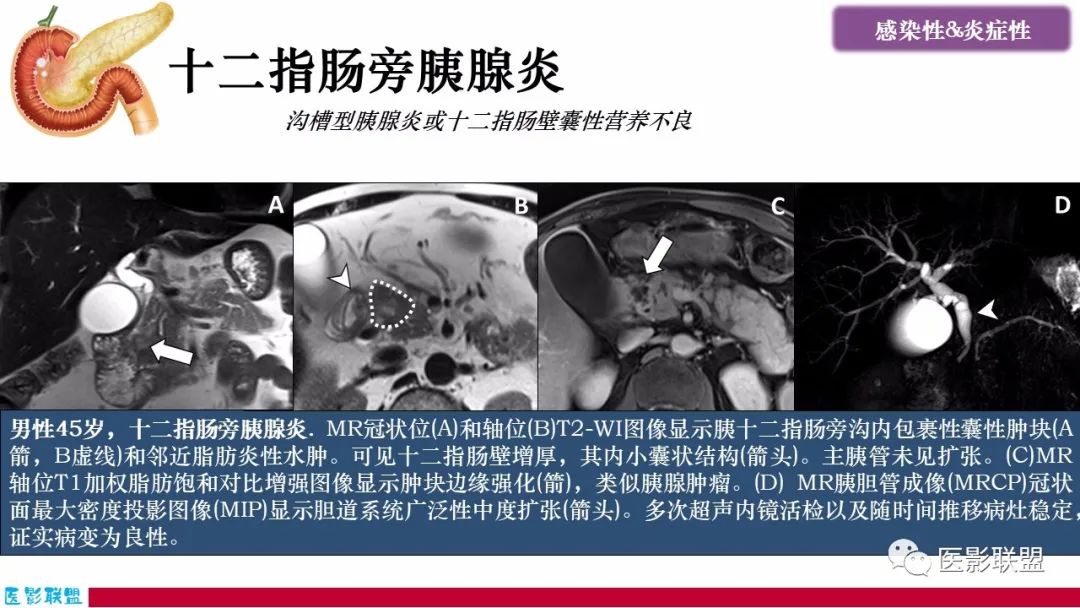 影像PPT - 【PPT】十二指肠断面成像：疾病谱-12