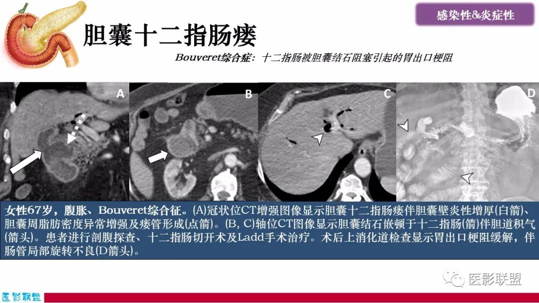 影像PPT - 【PPT】十二指肠断面成像：疾病谱-16