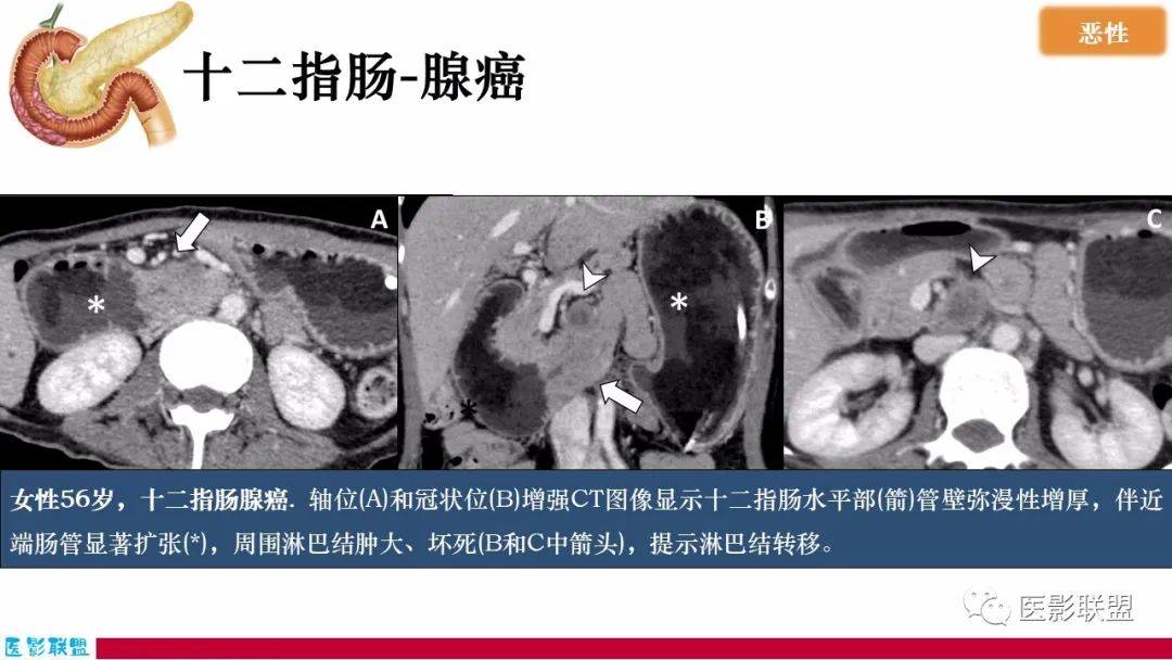 影像PPT - 【PPT】十二指肠断面成像：疾病谱-20