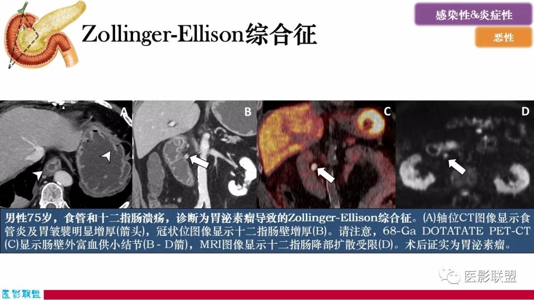 影像PPT - 【PPT】十二指肠断面成像：疾病谱-18