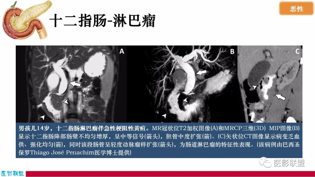 影像PPT - 【PPT】十二指肠断面成像：疾病谱-22