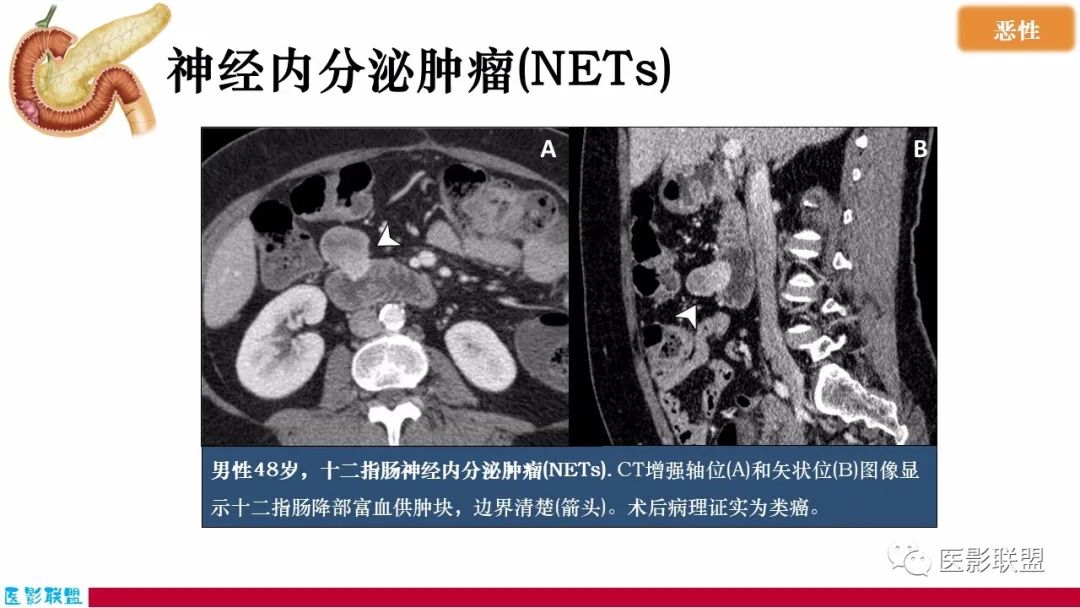 影像PPT - 【PPT】十二指肠断面成像：疾病谱-24