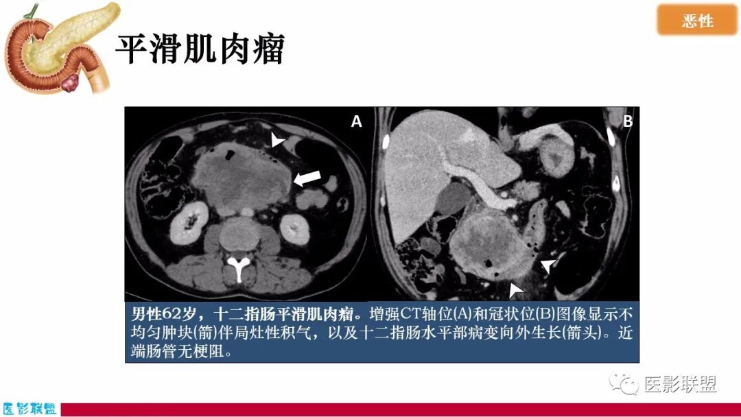 影像PPT - 【PPT】十二指肠断面成像：疾病谱-26