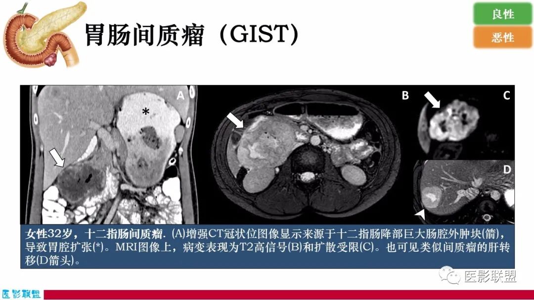 影像PPT - 【PPT】十二指肠断面成像：疾病谱-28