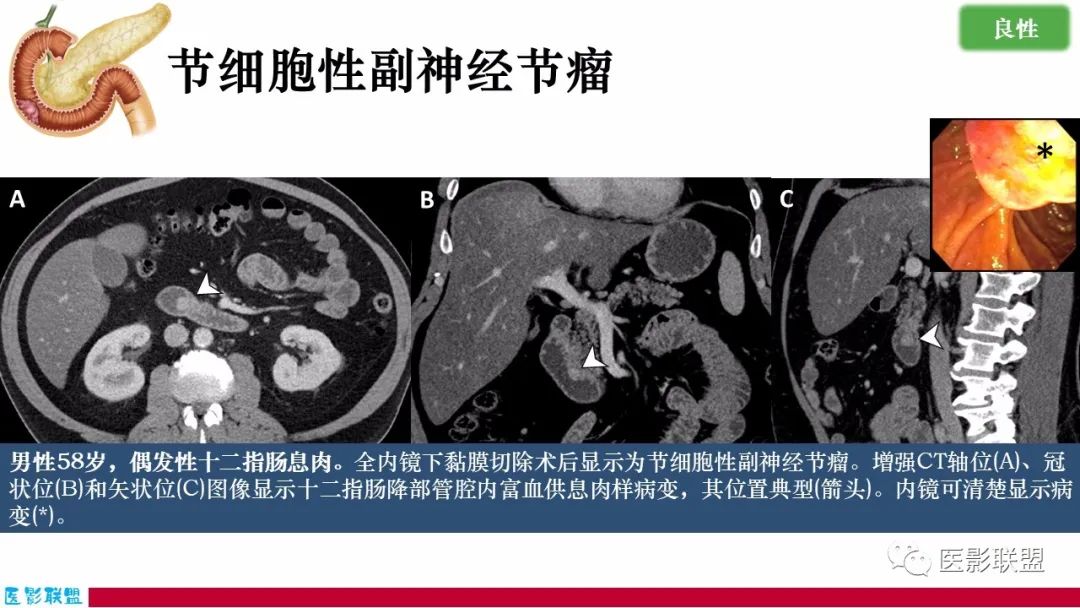 影像PPT - 【PPT】十二指肠断面成像：疾病谱-30
