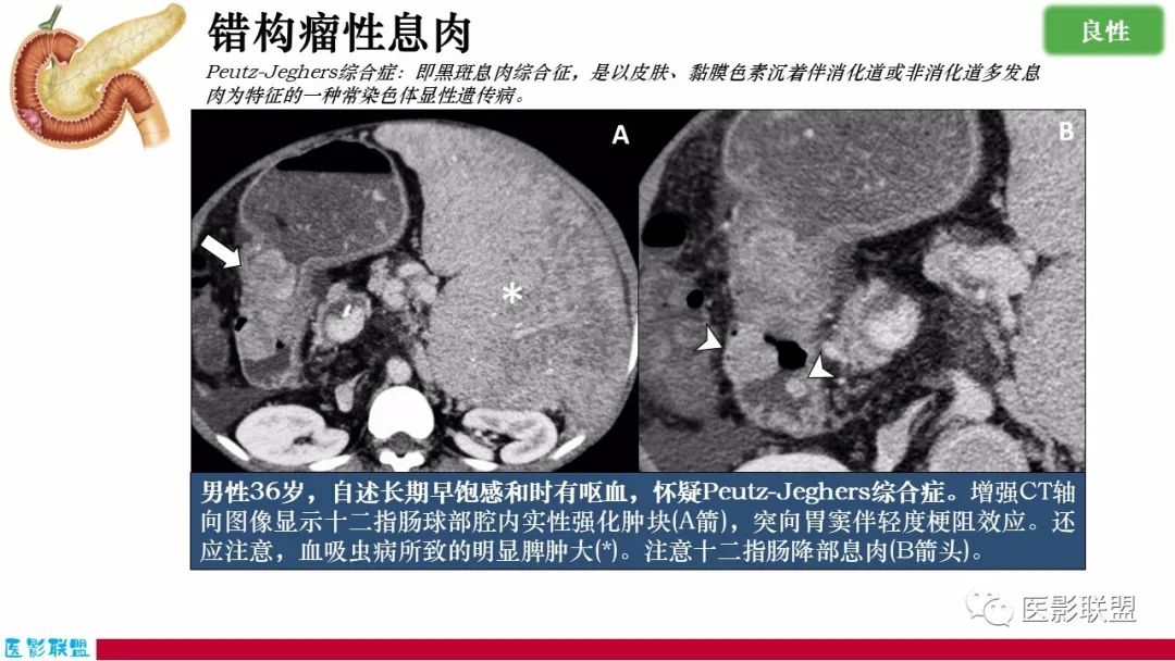 影像PPT - 【PPT】十二指肠断面成像：疾病谱-32