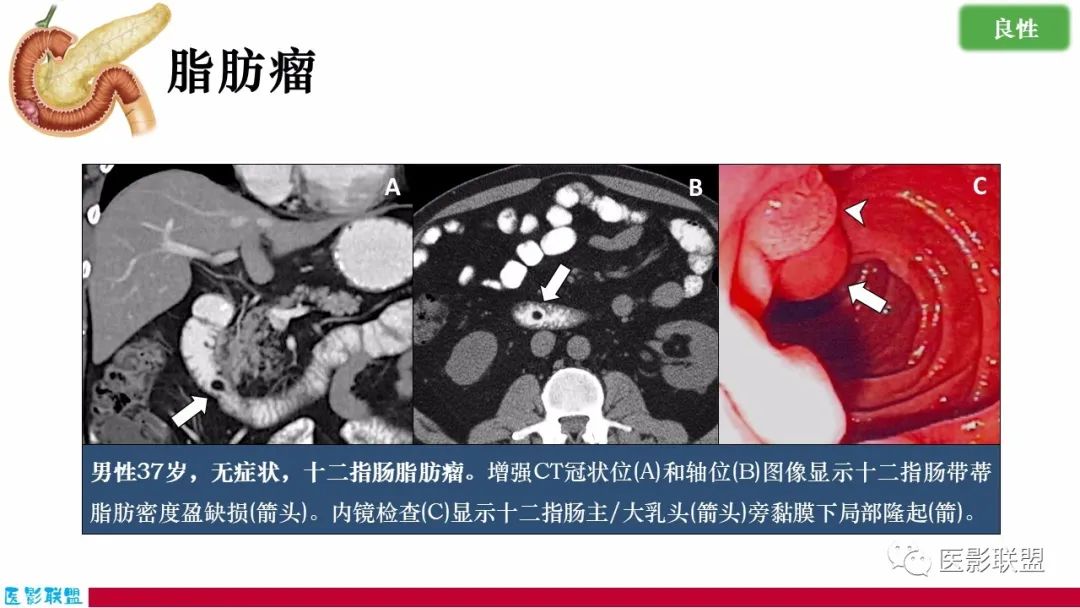 影像PPT - 【PPT】十二指肠断面成像：疾病谱-34