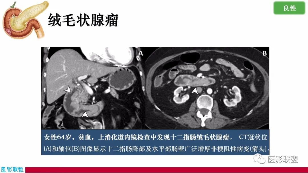 影像PPT - 【PPT】十二指肠断面成像：疾病谱-36