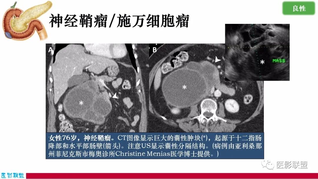 影像PPT - 【PPT】十二指肠断面成像：疾病谱-38