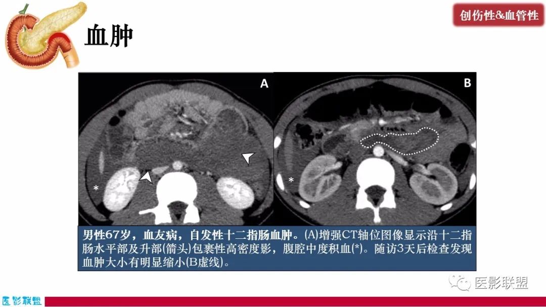 影像PPT - 【PPT】十二指肠断面成像：疾病谱-40