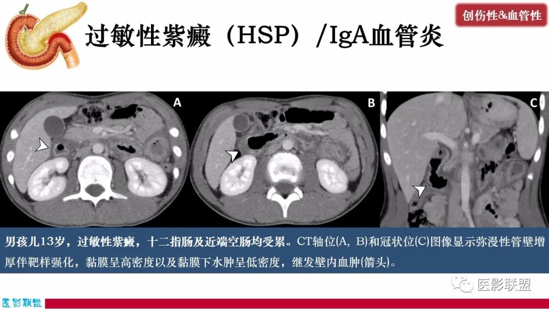 影像PPT - 【PPT】十二指肠断面成像：疾病谱-42