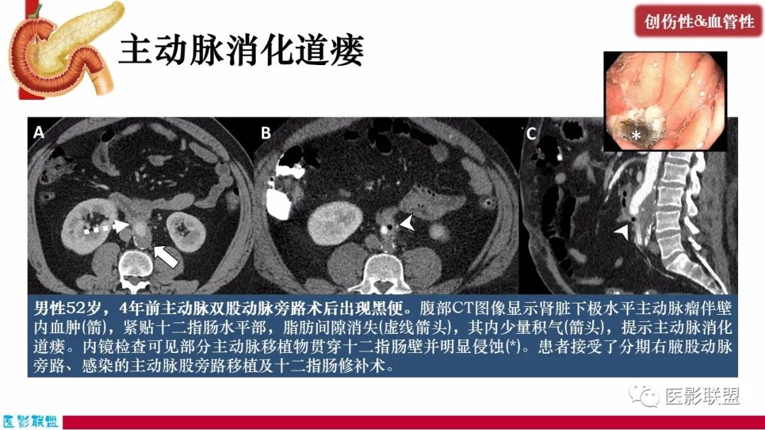影像PPT - 【PPT】十二指肠断面成像：疾病谱-44