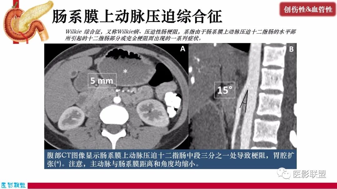 影像PPT - 【PPT】十二指肠断面成像：疾病谱-46