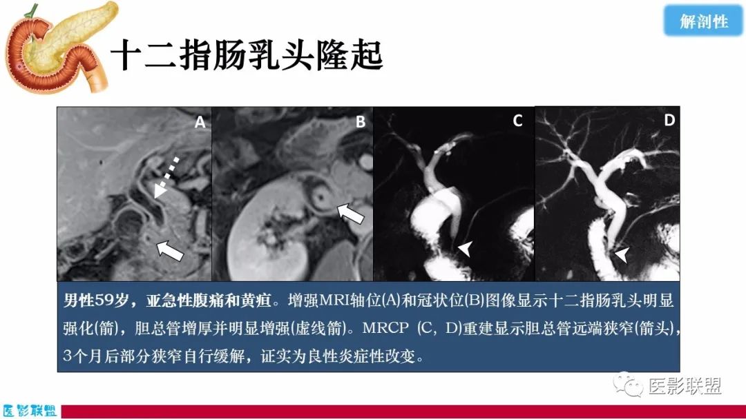 影像PPT - 【PPT】十二指肠断面成像：疾病谱-48