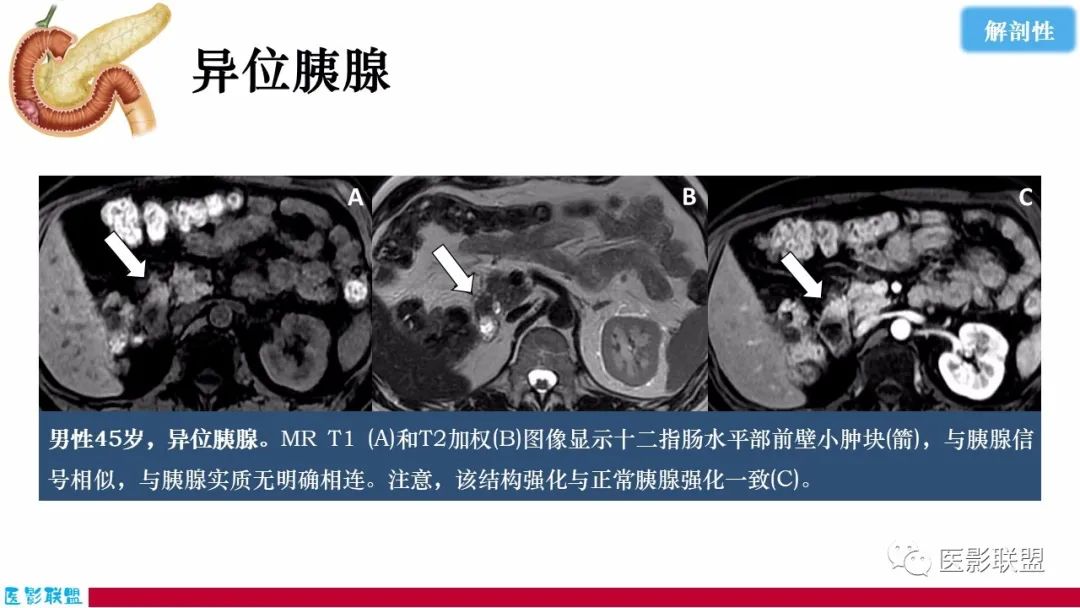 影像PPT - 【PPT】十二指肠断面成像：疾病谱-50