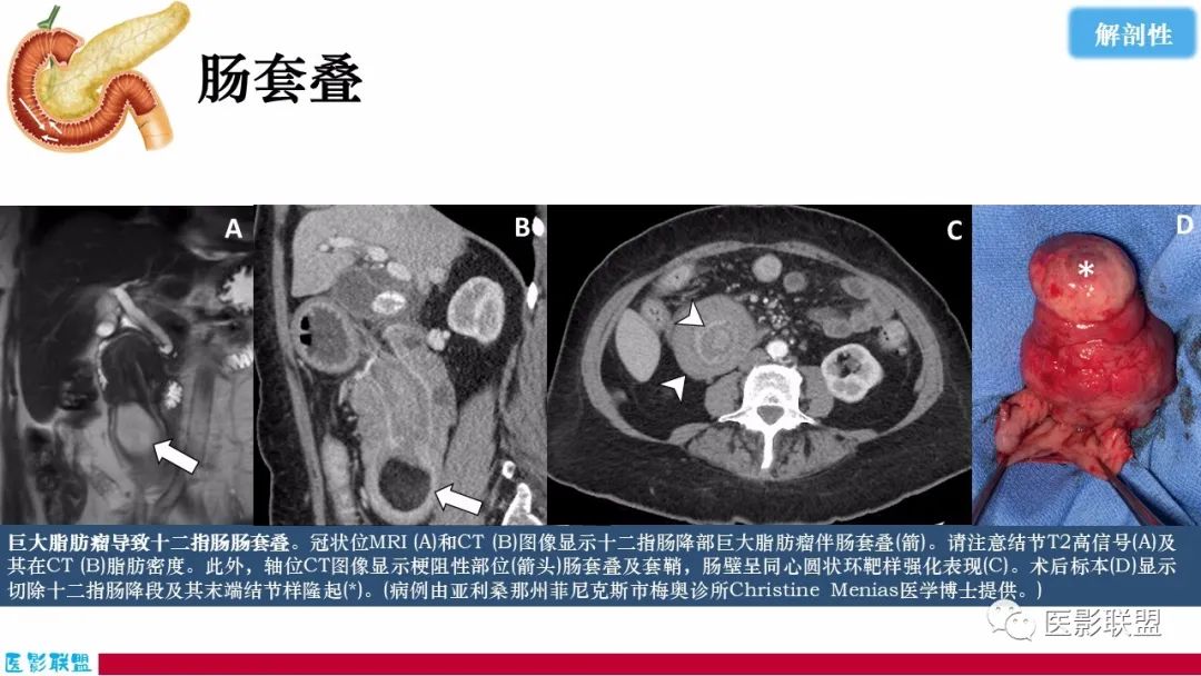 影像PPT - 【PPT】十二指肠断面成像：疾病谱-52