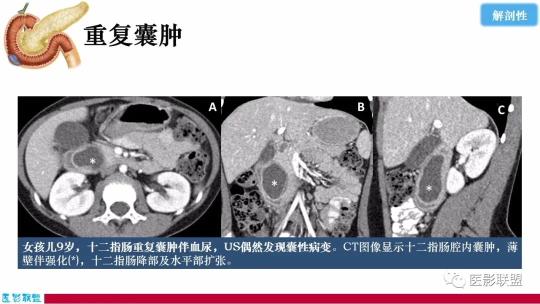 影像PPT - 【PPT】十二指肠断面成像：疾病谱-54
