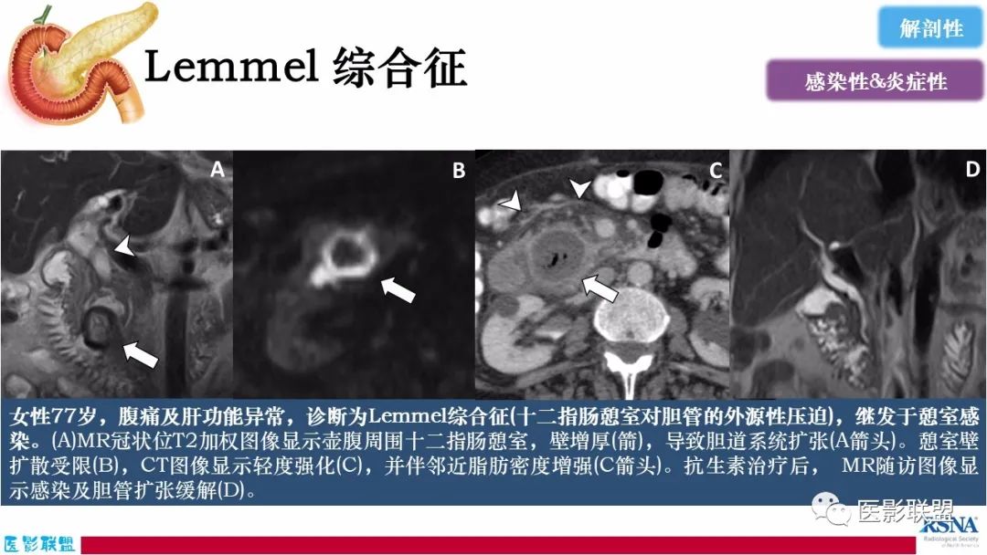 影像PPT - 【PPT】十二指肠断面成像：疾病谱-56