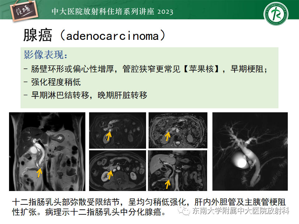 影像PPT - 【PPT】常见十二指肠占位影像诊断-6