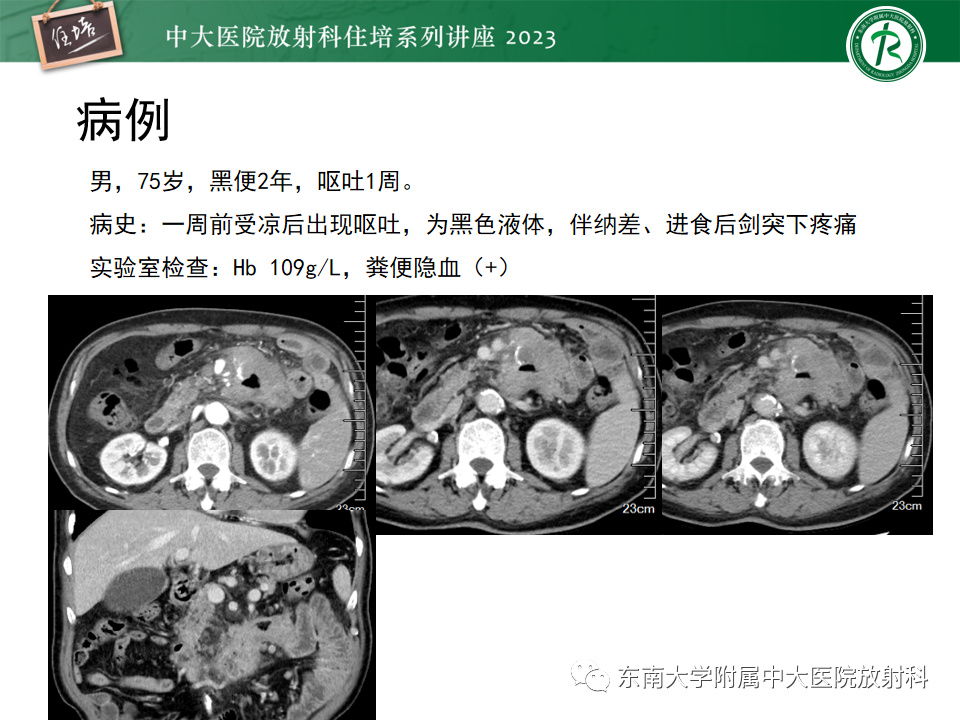 影像PPT - 【PPT】常见十二指肠占位影像诊断-7