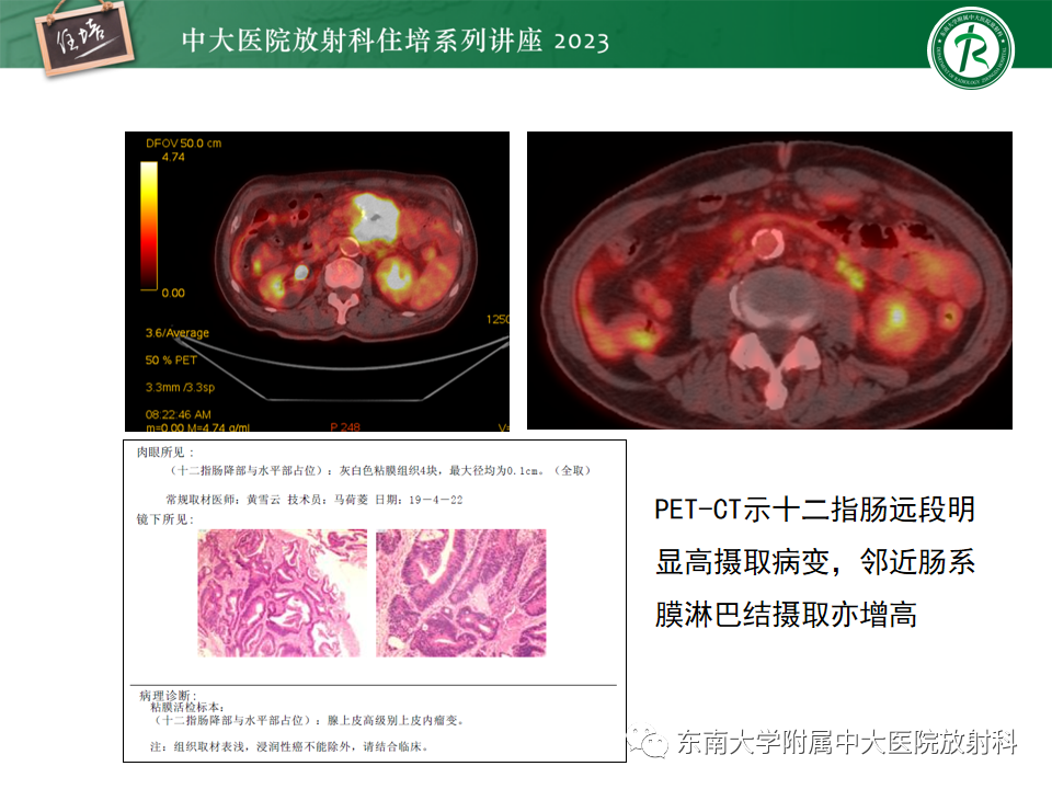 影像PPT - 【PPT】常见十二指肠占位影像诊断-8