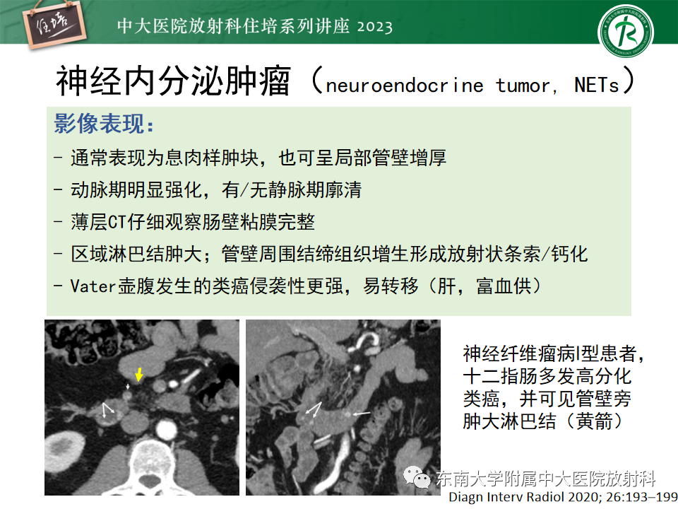 影像PPT - 【PPT】常见十二指肠占位影像诊断-12