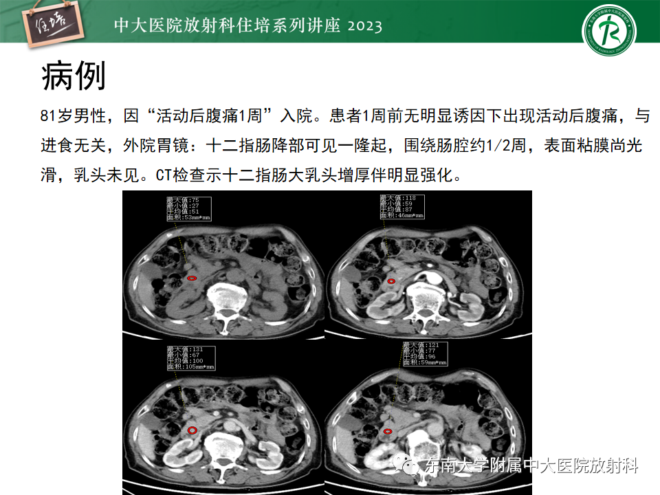 影像PPT - 【PPT】常见十二指肠占位影像诊断-13