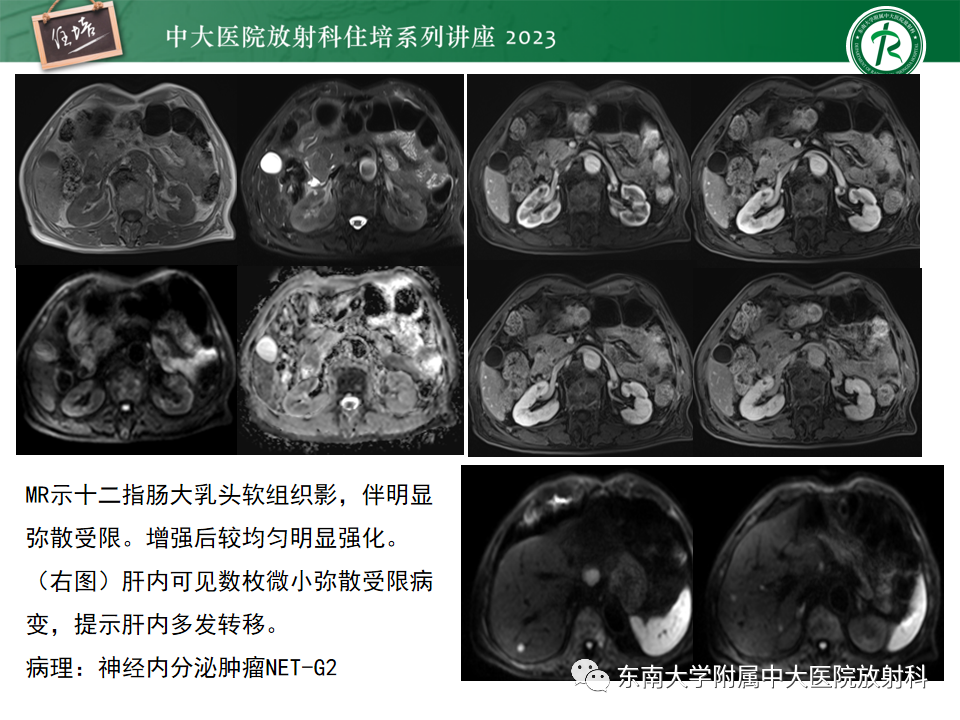 影像PPT - 【PPT】常见十二指肠占位影像诊断-14