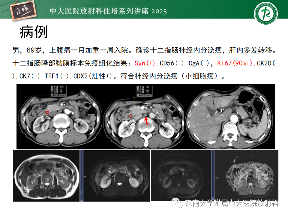 影像PPT - 【PPT】常见十二指肠占位影像诊断-15