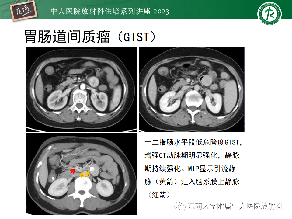 影像PPT - 【PPT】常见十二指肠占位影像诊断-18