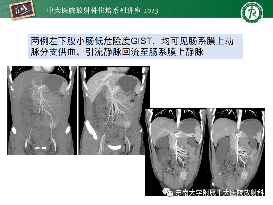 影像PPT - 【PPT】常见十二指肠占位影像诊断-19