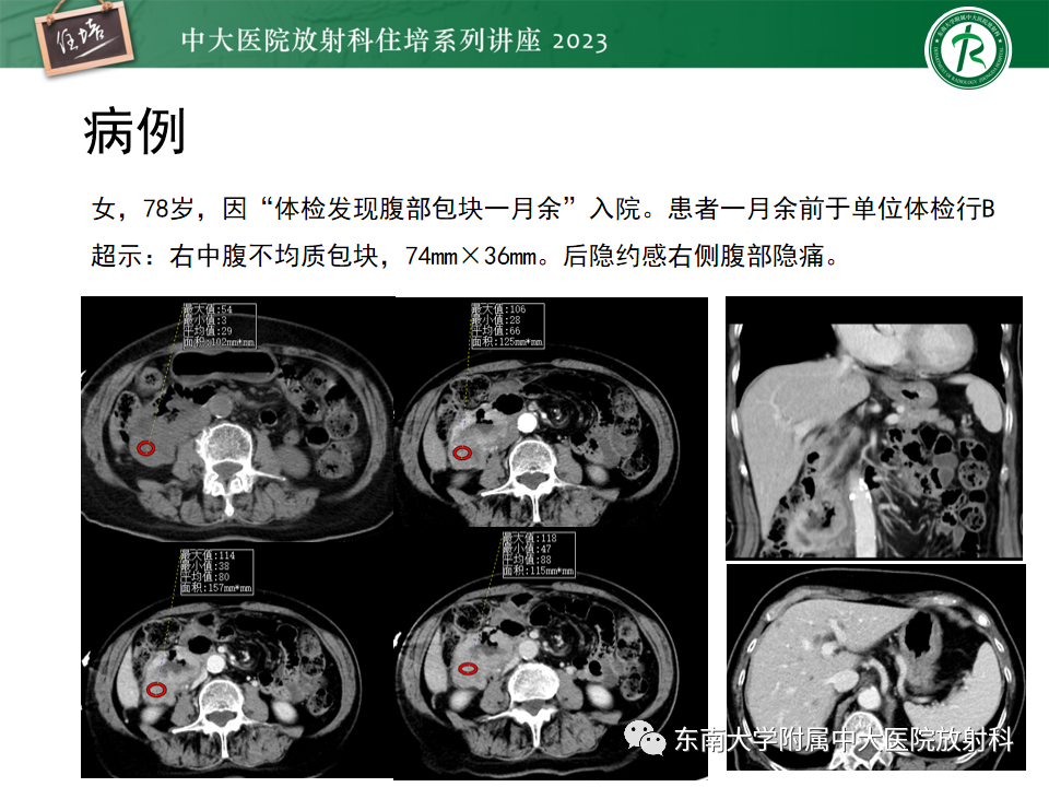 影像PPT - 【PPT】常见十二指肠占位影像诊断-21