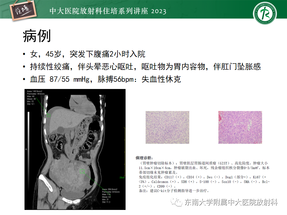影像PPT - 【PPT】常见十二指肠占位影像诊断-23