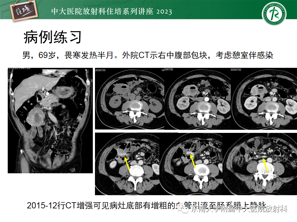 影像PPT - 【PPT】常见十二指肠占位影像诊断-25