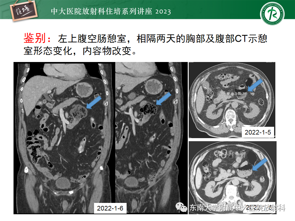 影像PPT - 【PPT】常见十二指肠占位影像诊断-28