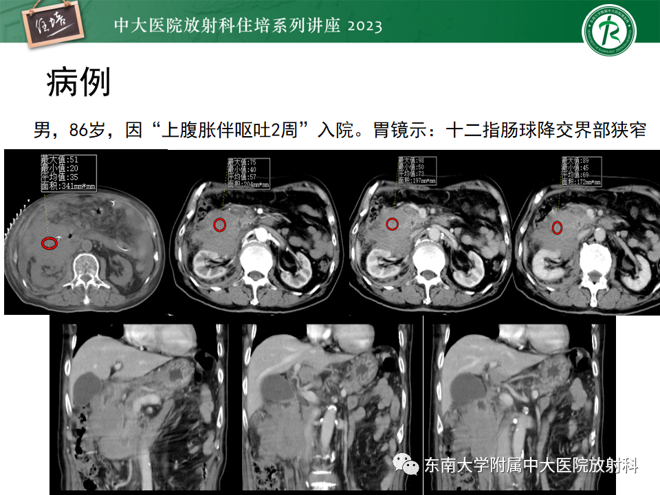 影像PPT - 【PPT】常见十二指肠占位影像诊断-33