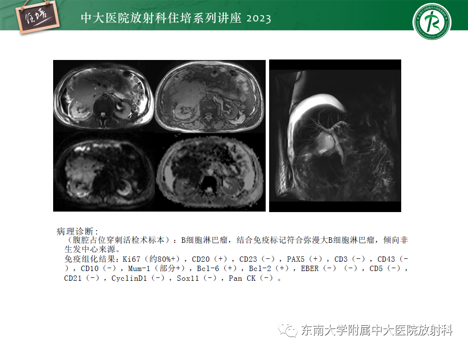 影像PPT - 【PPT】常见十二指肠占位影像诊断-34