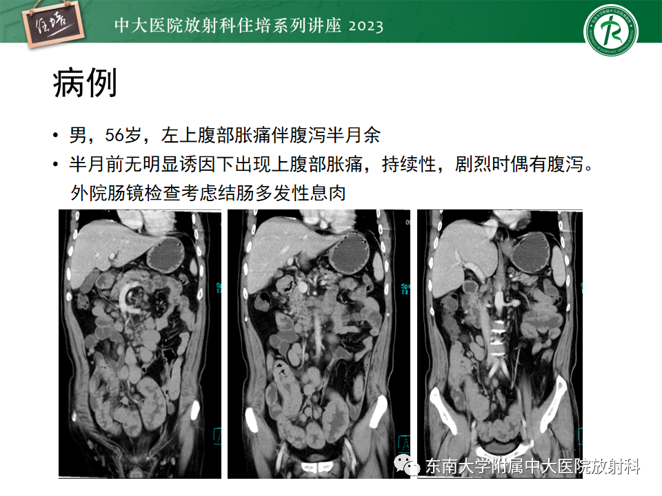 影像PPT - 【PPT】常见十二指肠占位影像诊断-35
